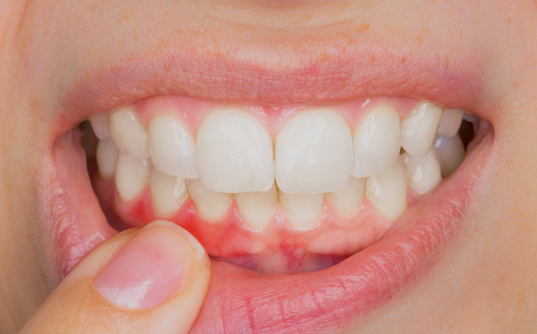 enfermedad periodontal en sevilla